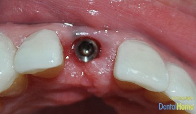 implante-dentales-en-medelllin-caso3c-dental-home-antes