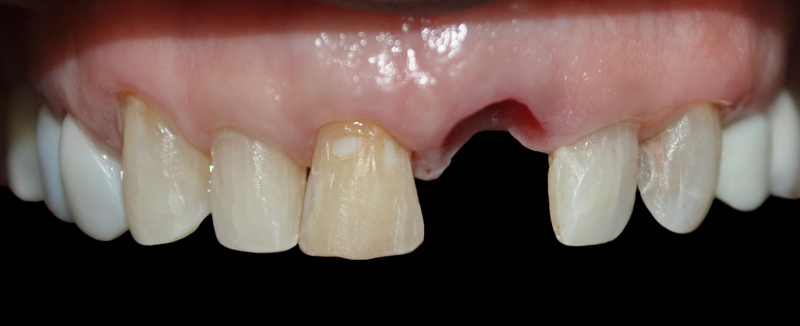 Dental implants medellin colombia 1