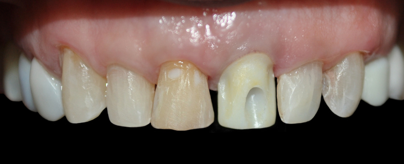 Dental implants medellin colombia 2