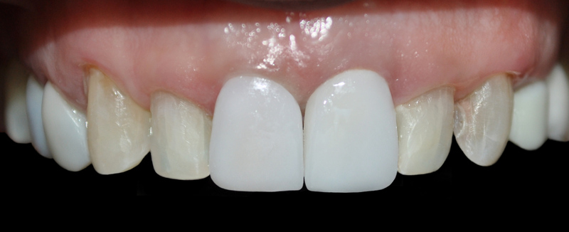 Dental implants medellin colombia 3