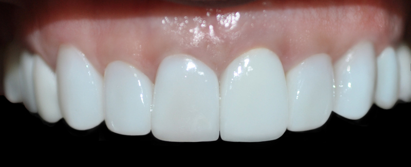 Dental implants medellin colombia 4