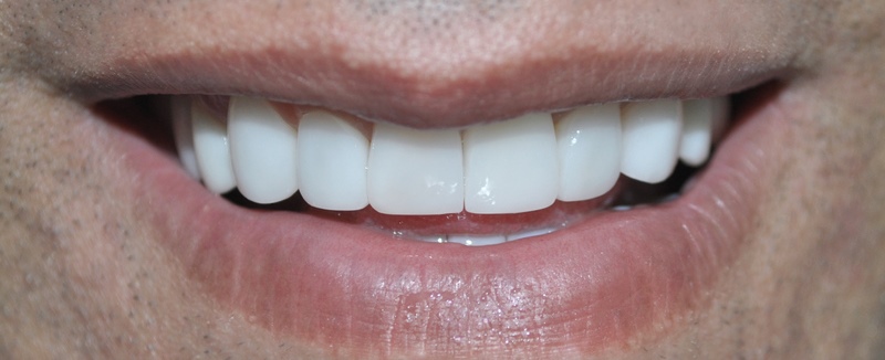 Dental implants medellin colombia 5