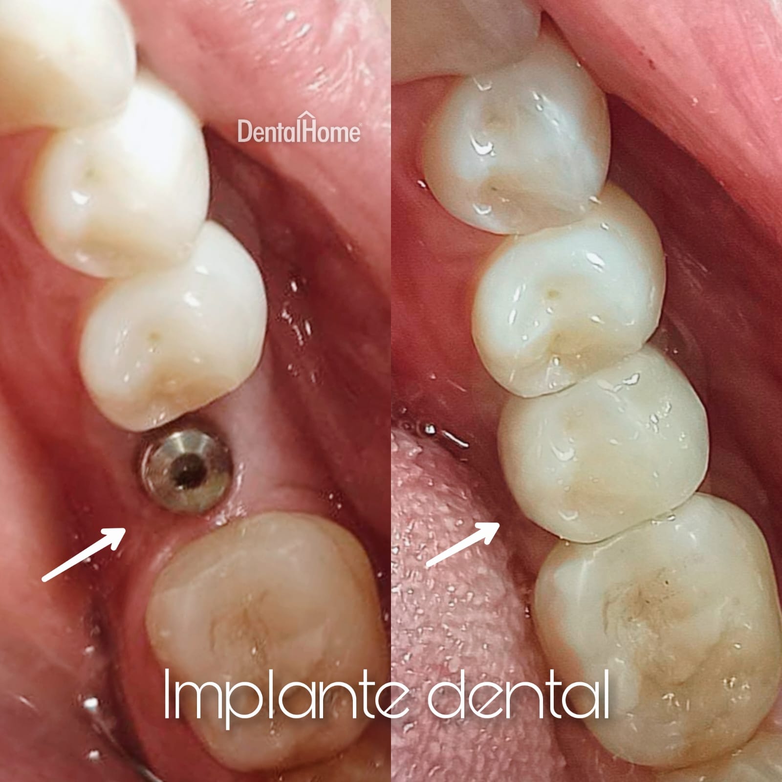 dental implant in medellin case study