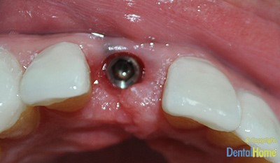 Before-Dental Implants D