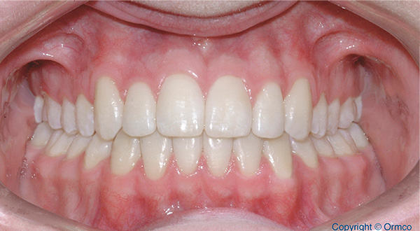 After-Orthodontics treatment case 1