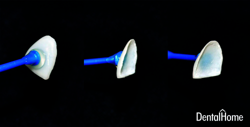 dental contact lenses veneers medellin