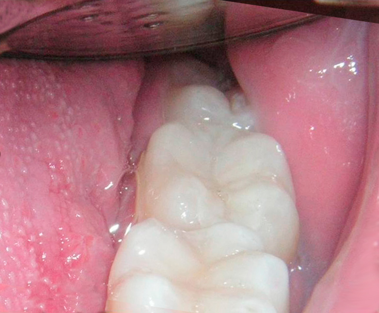 dental inlays case 1 after