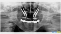 implante dental 2