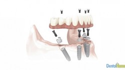 implantes dentales medellin