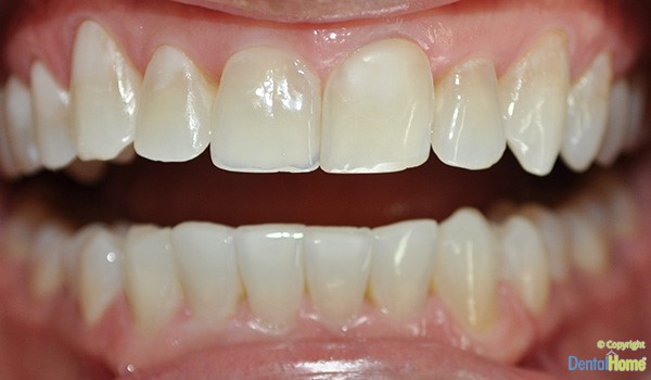 Before-Lentes de contacto dental