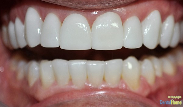 After-Lentes de contacto dental