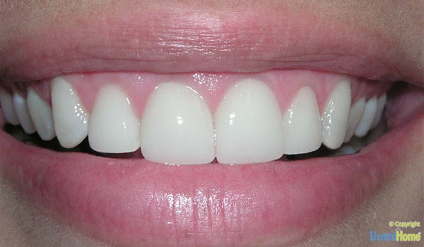 After-Lentes de contacto dentaL