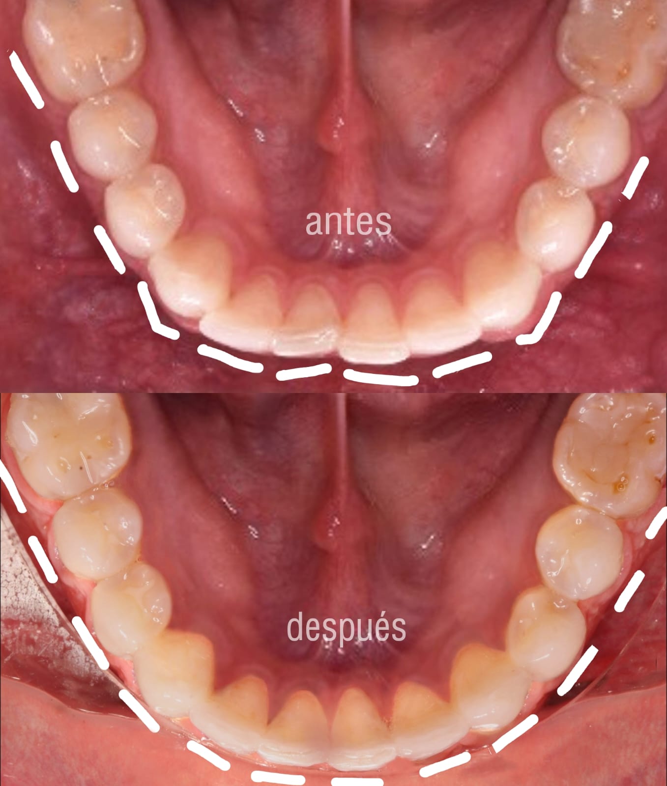 alineadores-dentales-antes-despues